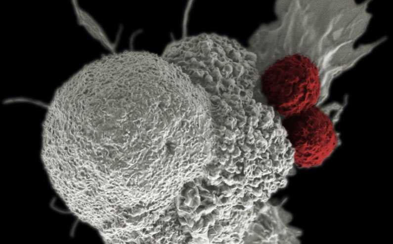 病例報(bào)告：BNCT治療腦干膠質(zhì)瘤