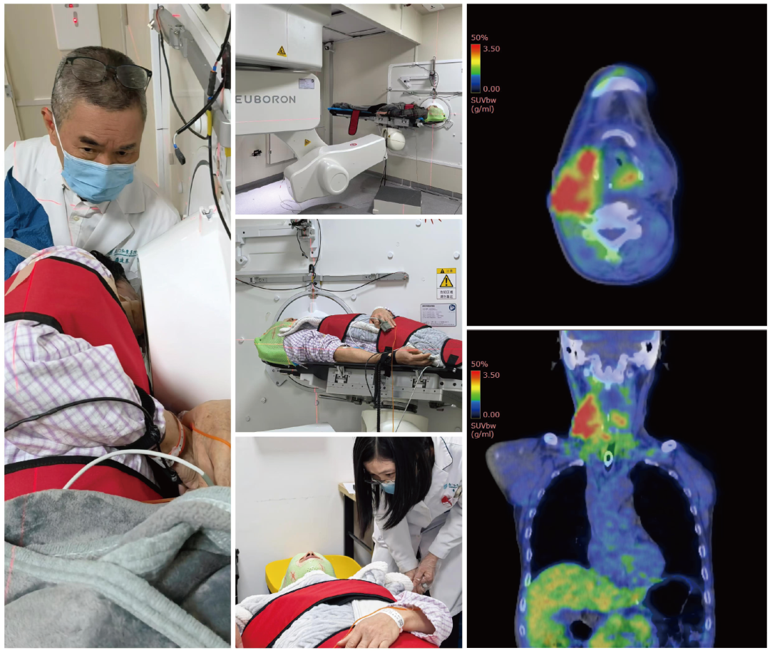 2025中國BNCT新啟航新突破！18F-BPA獲批IND，BPA啟動臨床Ib
